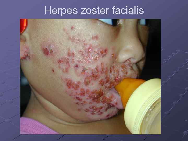 Herpes zoster facialis 