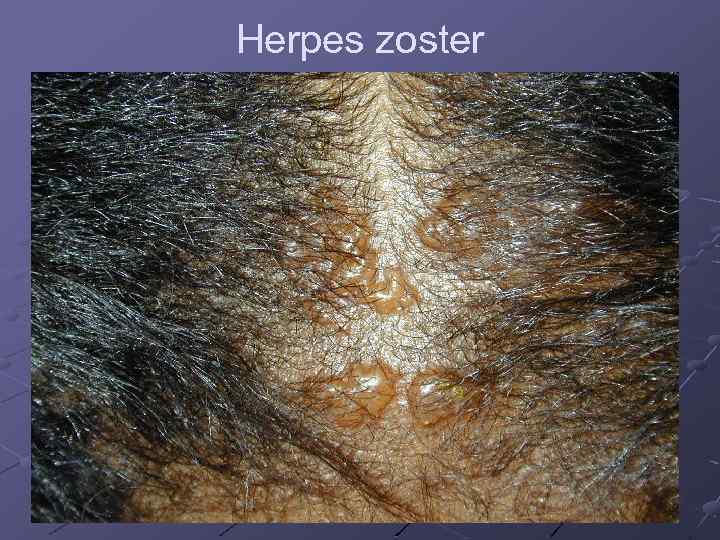 Herpes zoster 