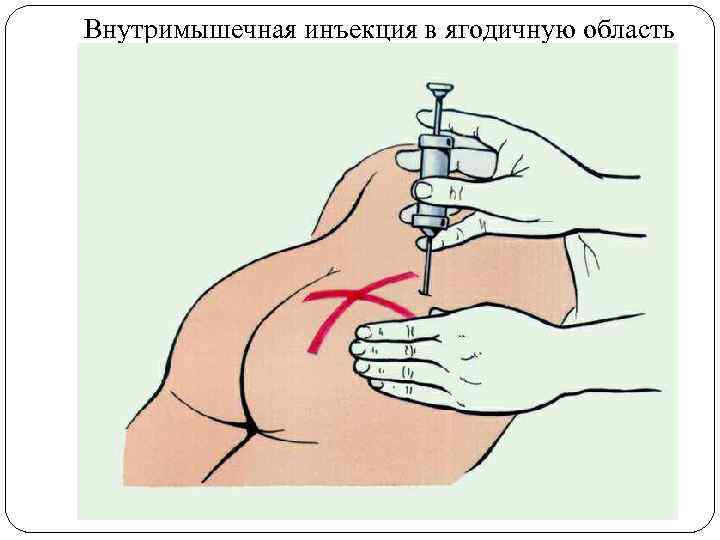 Внутримышечная инъекция в ягодичную область 