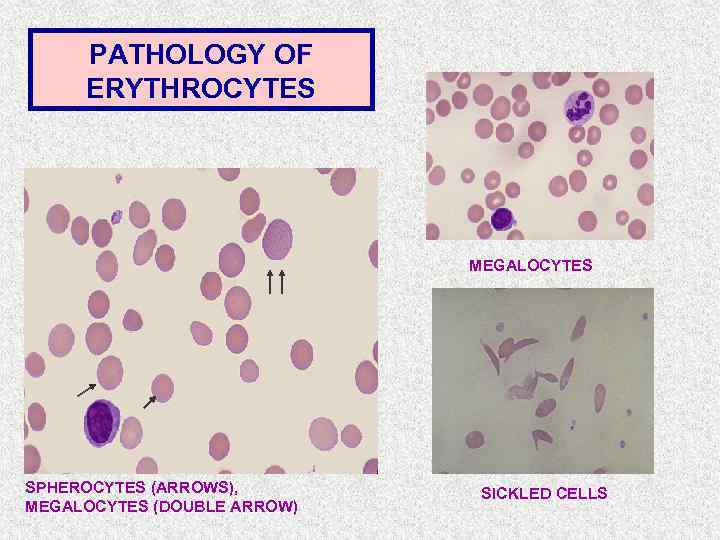 PATHOLOGY OF ERYTHROCYTES MEGALOCYTES SPHEROCYTES (ARROWS), MEGALOCYTES (DOUBLE ARROW) SICKLED CELLS 