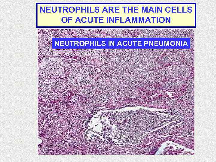 NEUTROPHILS ARE THE MAIN CELLS OF ACUTE INFLAMMATION NEUTROPHILS IN ACUTE PNEUMONIA 