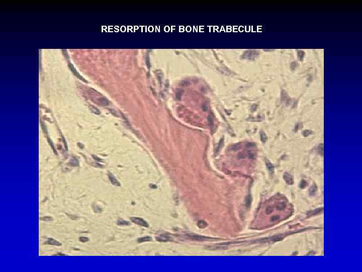 RESORPTION OF BONE TRABECULE 