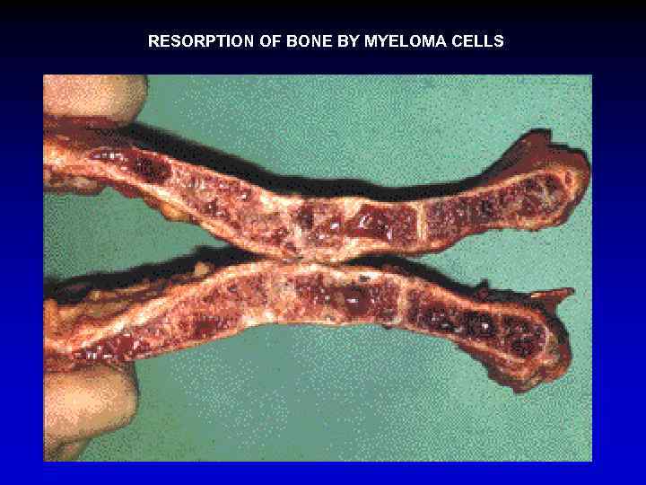 RESORPTION OF BONE BY MYELOMA CELLS 