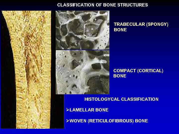 CLASSIFICATION OF BONE STRUCTURES TRABECULAR (SPONGY) BONE COMPACT (CORTICAL) BONE HISTOLOGYCAL CLASSIFICATION ØLAMELLAR BONE