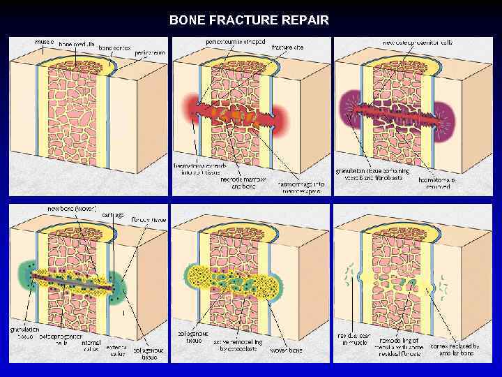 BONE FRACTURE REPAIR 