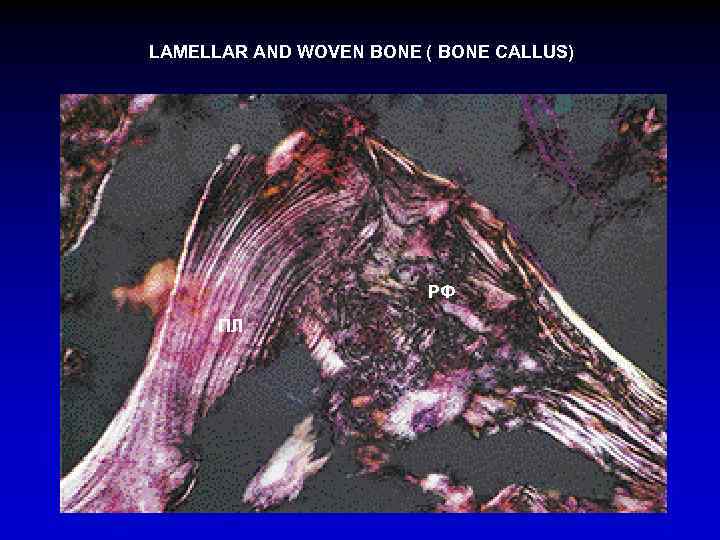 LAMELLAR AND WOVEN BONE ( BONE CALLUS) РФ ПЛ 