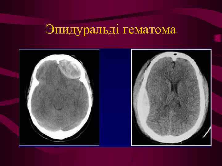 Эпидуральді гематома 