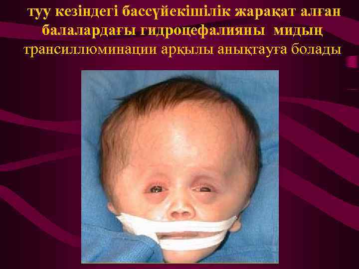туу кезіндегі бассүйекішілік жарақат алған балалардағы гидроцефалияны мидың трансиллюминации арқылы анықтауға болады. 