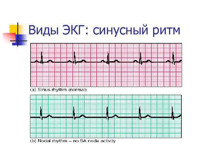 Виды ЭКГ: синусный ритм 