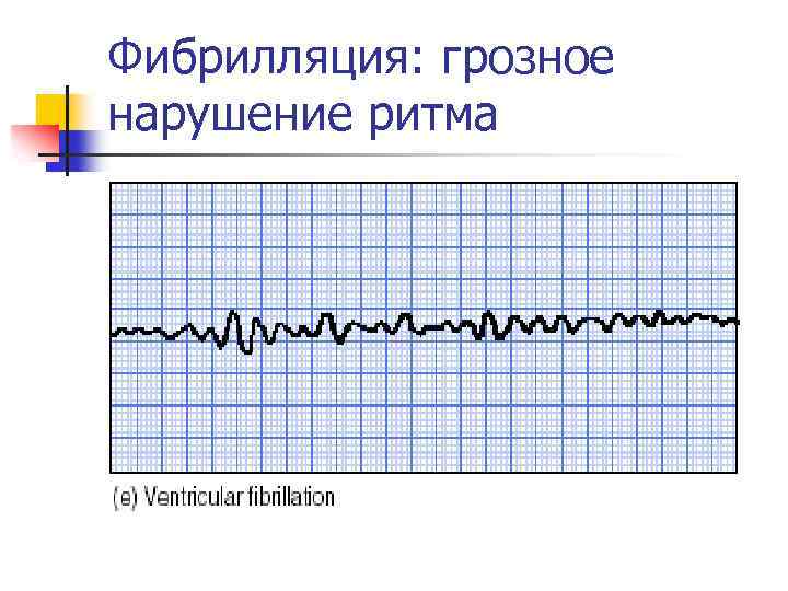 Фибрилляция: грозное нарушение ритма 