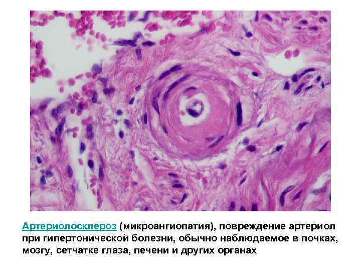 Артериолосклероз (микроангиопатия), повреждение артериол при гипертонической болезни, обычно наблюдаемое в почках, мозгу, сетчатке глаза,