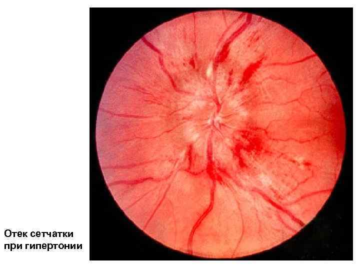 Отек сетчатки при гипертонии 