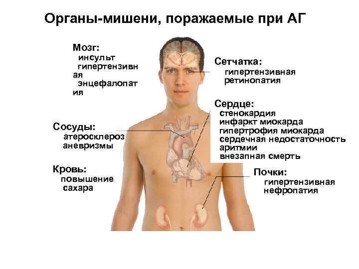 Органы-мишени, поражаемые при АГ Мозг: инсульт гипертензивн ая энцефалопат ия Сетчатка: гипертензивная ретинопатия Сердце: