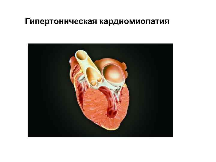Гипертоническая кардиомиопатия 