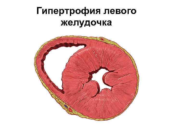 Гипертрофия левого желудочка 