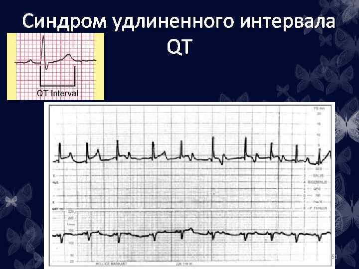 Удлинение qt. Синдром короткого интервала q-t. Синдром короткого qt на ЭКГ. Синдром удлиненного интервала qt. Синдром короткого интервала qt.