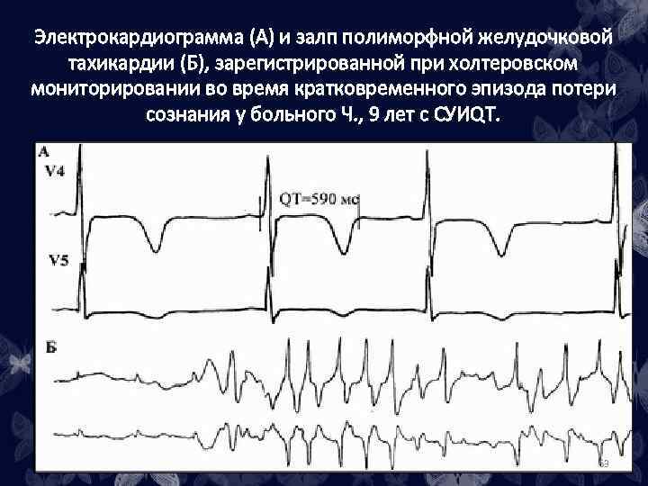 Электрокардиограмма (А) и залп полиморфной желудочковой тахикардии (Б), зарегистрированной при холтеровском мониторировании во время