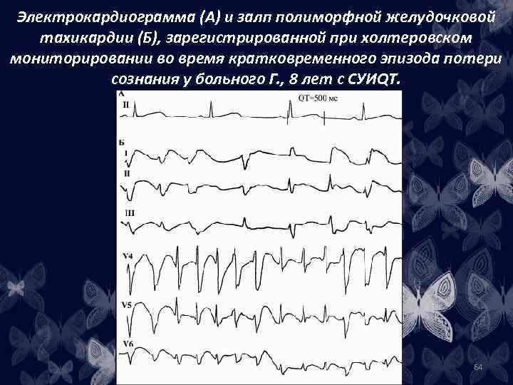 Электрокардиограмма (А) и залп полиморфной желудочковой тахикардии (Б), зарегистрированной при холтеровском мониторировании во время