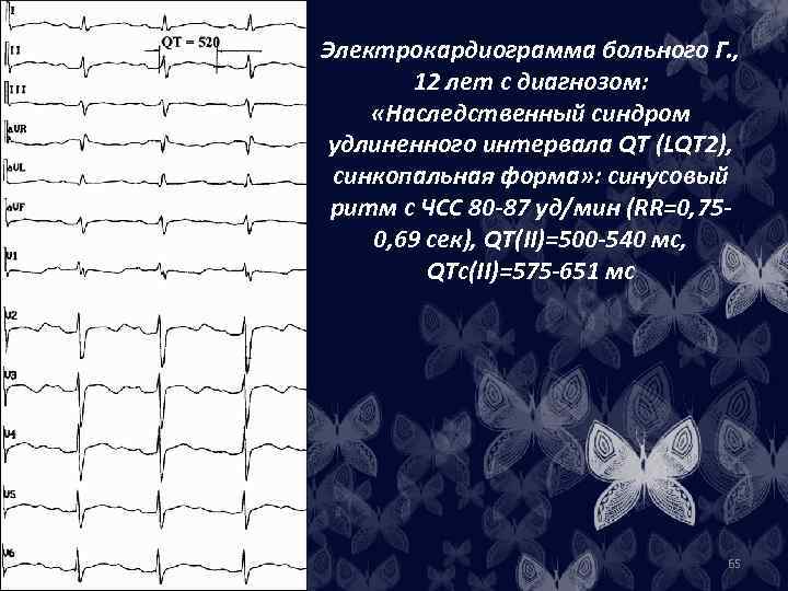 Электрокардиограмма больного Г. , 12 лет с диагнозом: «Наследственный синдром удлиненного интервала QT (LQT