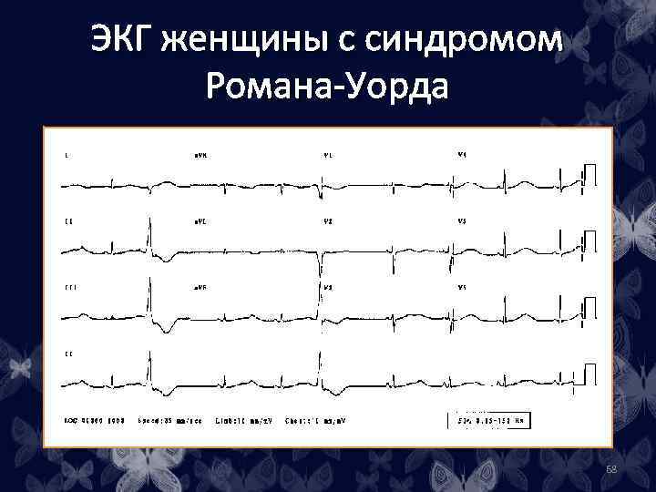 ЭКГ женщины с синдромом Романа-Уорда 68 