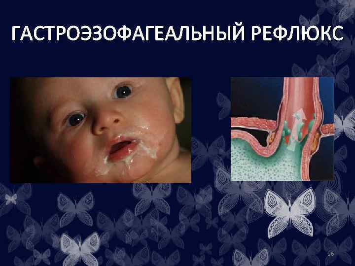 ГАСТРОЭЗОФАГЕАЛЬНЫЙ РЕФЛЮКС 96 