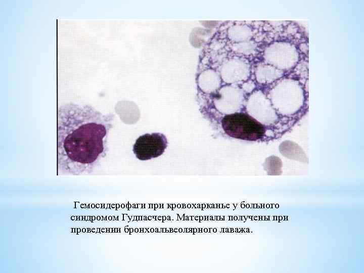 Гемосидерофаги при кровохарканье у больного синдромом Гудпасчера. Материалы получены при проведении бронхоальвеолярного лаважа. 
