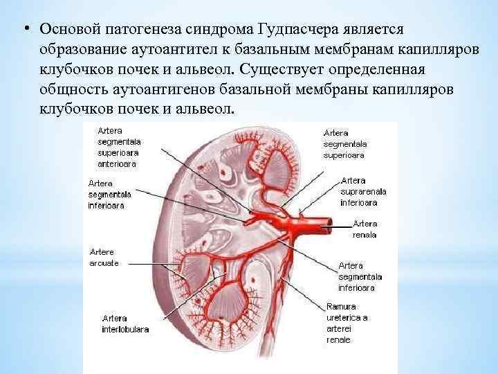  • Основой патогенеза синдрома Гудпасчера является образование аутоантител к базальным мембранам капилляров клубочков