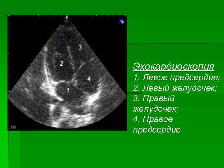 Эхокардиоскопия 1. Левое предсердие; 2. Левый желудочек; 3. Правый желудочек; 4. Правое предсердие 