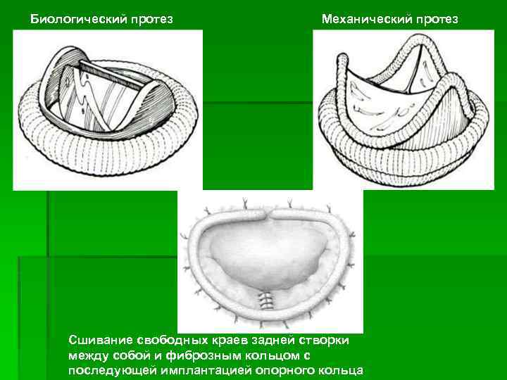 Биологический протез Механический протез Сшивание свободных краев задней створки между собой и фиброзным кольцом