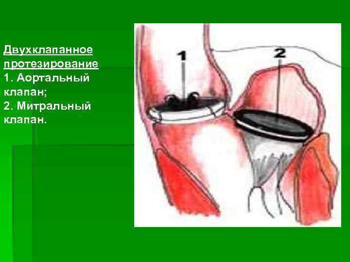Двухклапанное протезирование 1. Аортальный клапан; 2. Митральный клапан. 