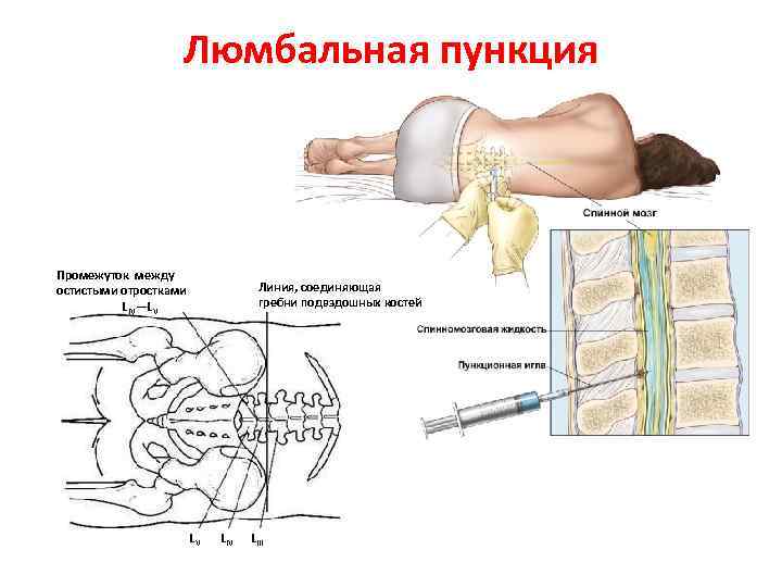 Люмбальная пункция Промежуток между остистыми отростками L IV—LV Линия, соединяющая гребни подвздошных костей LV