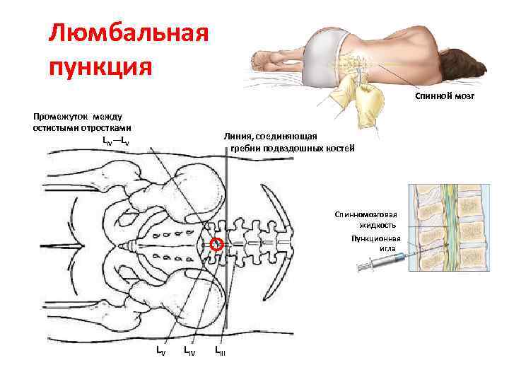 Люмбальная пункция Спинной мозг Промежуток между остистыми отростками LIV—LV Линия, соединяющая гребни подвздошных костей