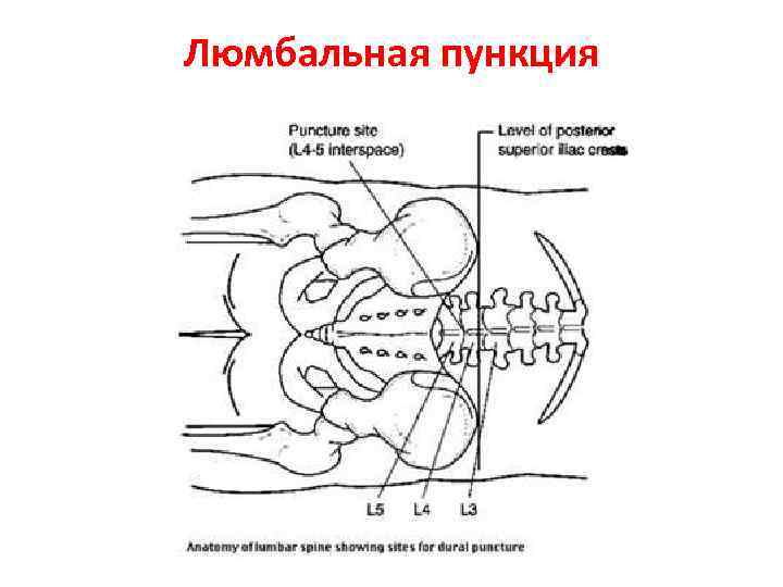 Люмбальная пункция 