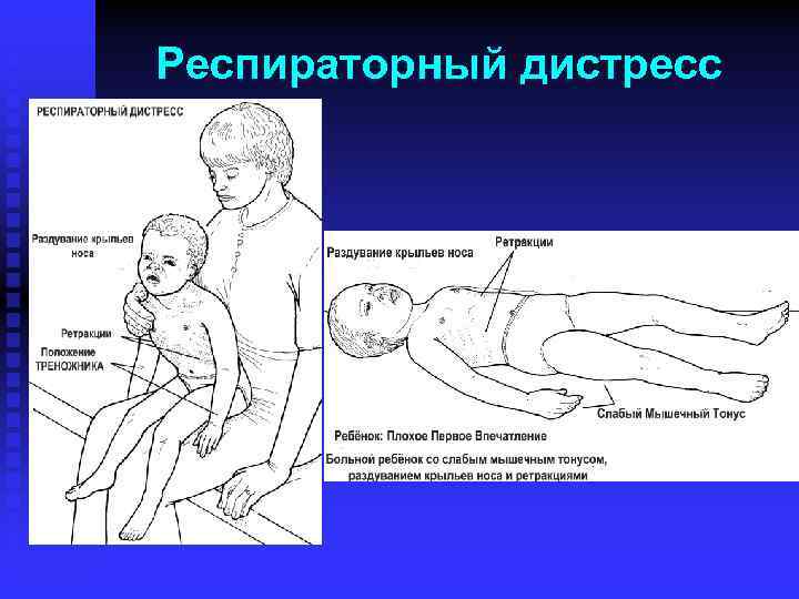 Респираторный дистресс 