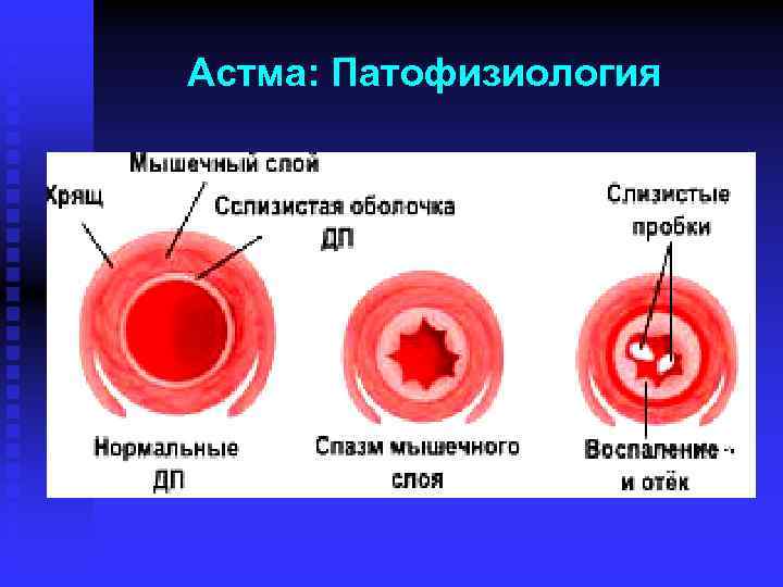 Астма: Патофизиология 