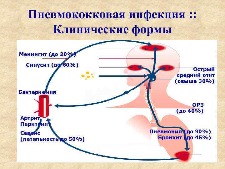 Пневмококковая инфекция : : Клинические формы Менингит (до 20%) Синусит (до 60%) Острый средний