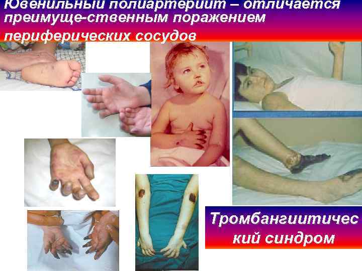Ювенильный полиартериит – отличается преимуще-ственным поражением периферических сосудов Тромбангиитичес кий синдром 