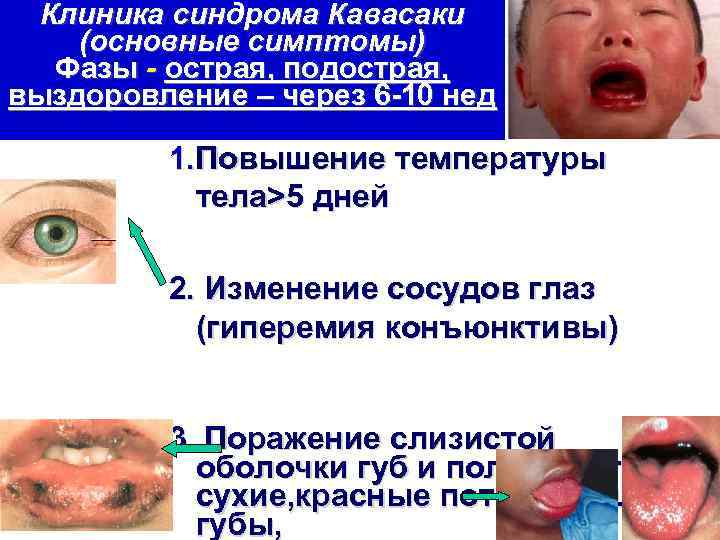 Клиника синдрома Кавасаки (основные симптомы) Фазы - острая, подострая, выздоровление – через 6 -10