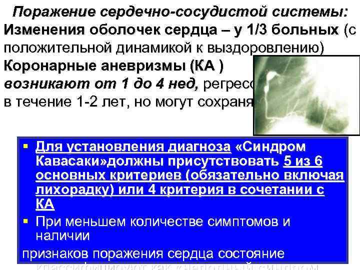 Поражение сердечно-сосудистой системы: Изменения оболочек сердца – у 1/3 больных (с положительной динамикой к
