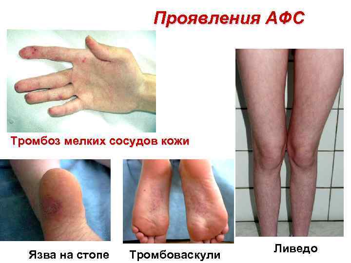 Проявления АФС Тромбоз мелких сосудов кожи Язва на стопе Тромбоваскули Ливедо 