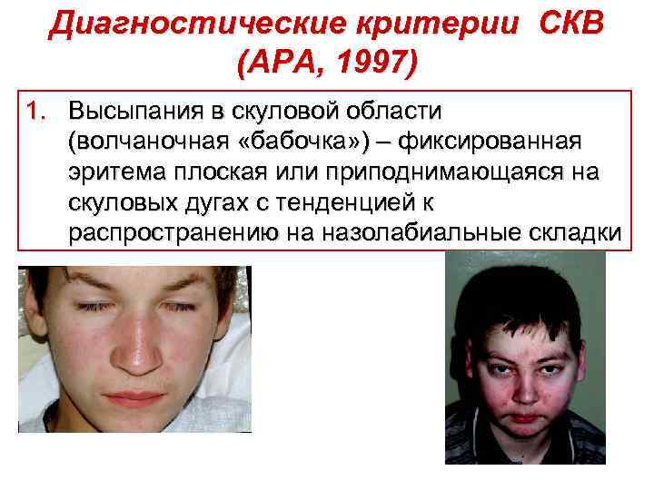 Диагностические критерии СКВ (АРА, 1997) 1. Высыпания в скуловой области (волчаночная «бабочка» ) –