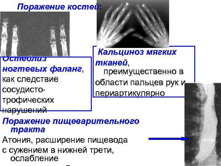 Поражение костей. Кальциноз периартикулярных тканей остеопороз. Кальциноз мягких тканей. Периартикулярные мягкие ткани.