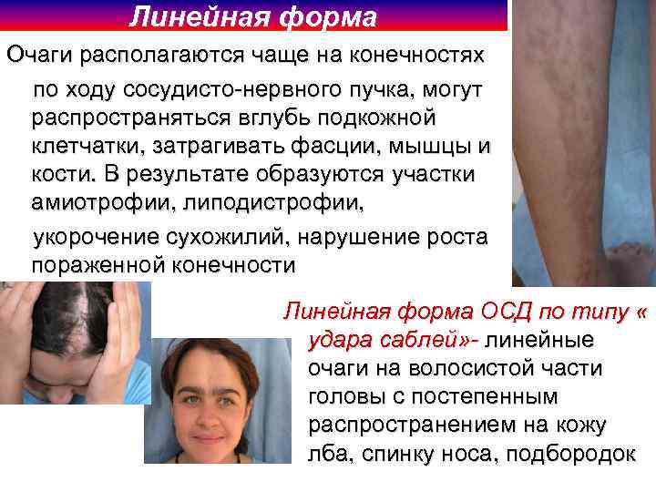 Линейная форма Очаги располагаются чаще на конечностях по ходу сосудисто-нервного пучка, могут распространяться вглубь