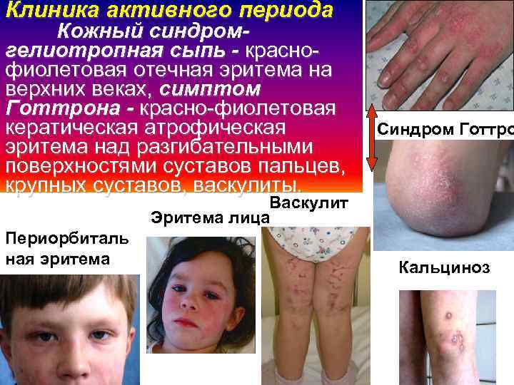 Клиника активного периода Кожный синдромгелиотропная сыпь - краснофиолетовая отечная эритема на верхних веках, симптом