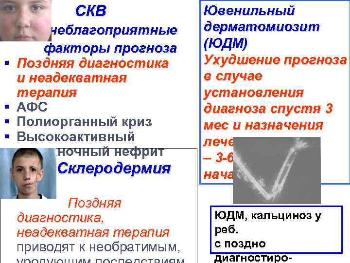 СКВ § § неблагоприятные факторы прогноза Поздняя диагностика и неадекватная терапия АФС Полиорганный криз