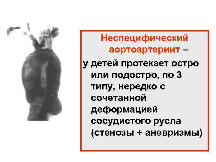 Неспецифический аортоартериит – у детей протекает остро или подостро, по 3 типу, нередко с