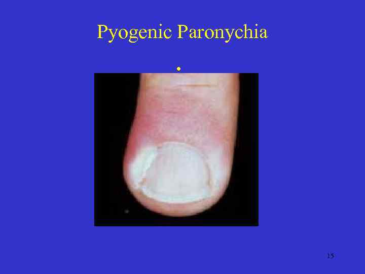 Pyogenic Paronychia • 15 