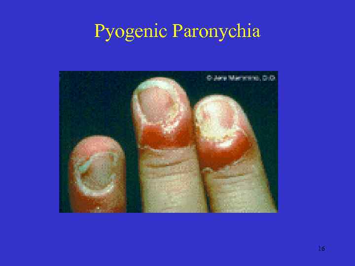 Pyogenic Paronychia 16 