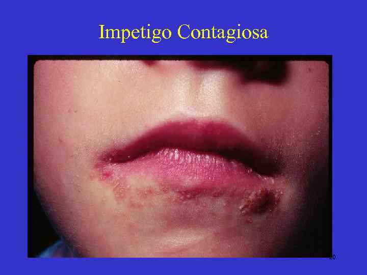 Impetigo Contagiosa • 20 