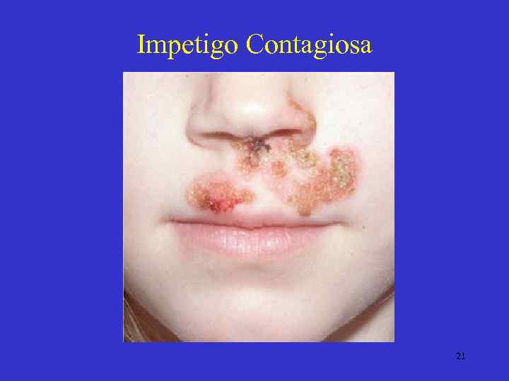 Impetigo Contagiosa 21 